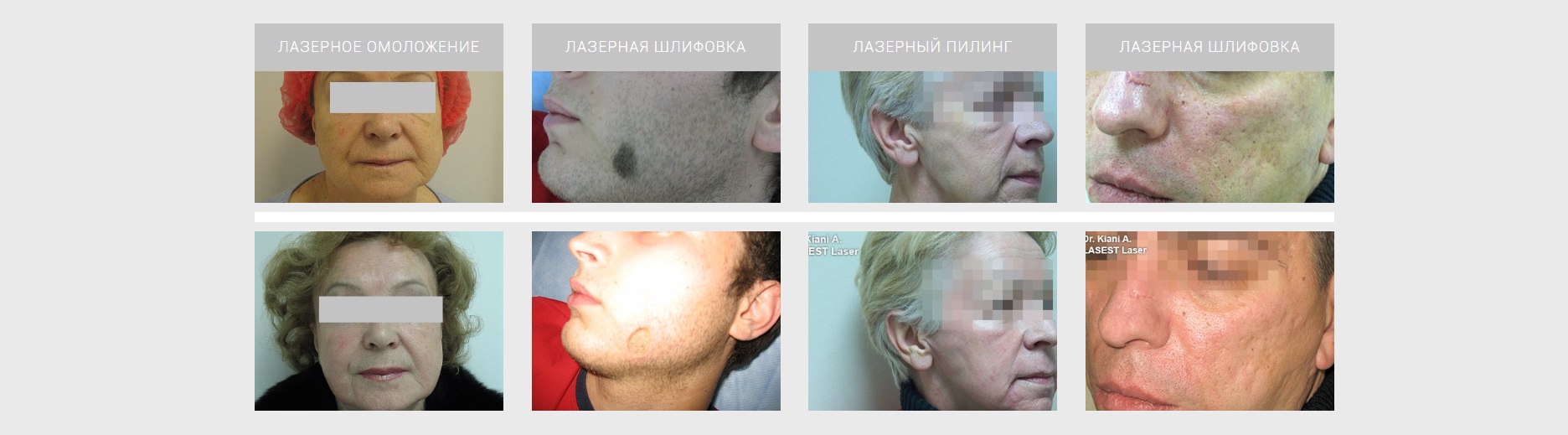 Результат со2 лазера