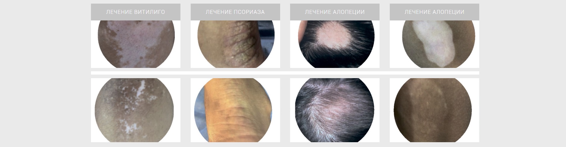 Результат эксимерного лазера