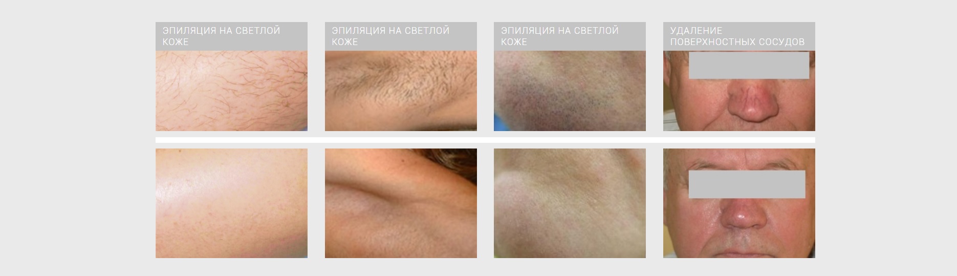 Результаты александритового лазера