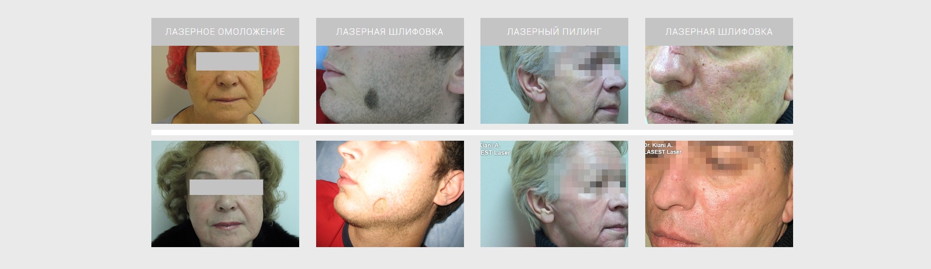 Результаты эрбиевого лазера